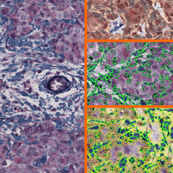 ihc_tumor-stroma_app