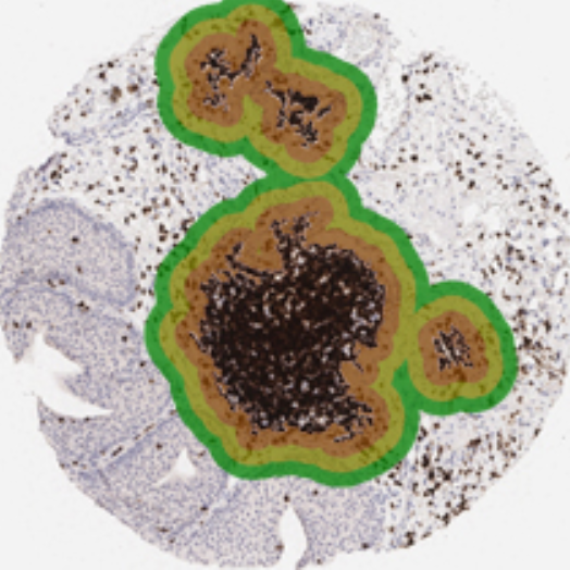 tumor_immunology