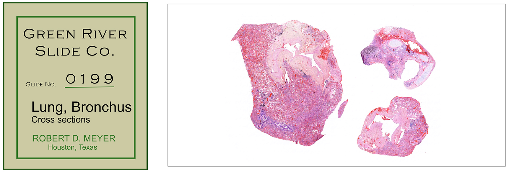 199_lung_bronchus-ds_sm