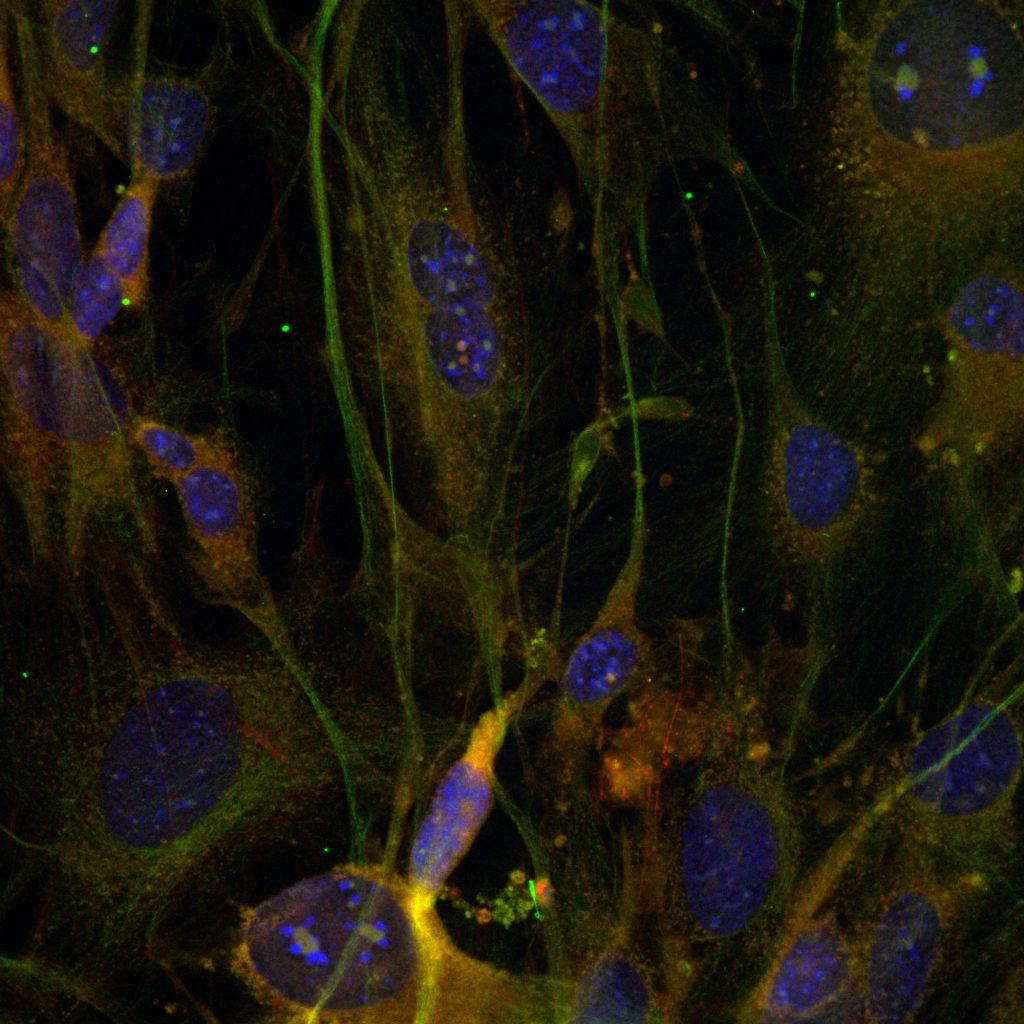 melanoma_2025-03-13_175639